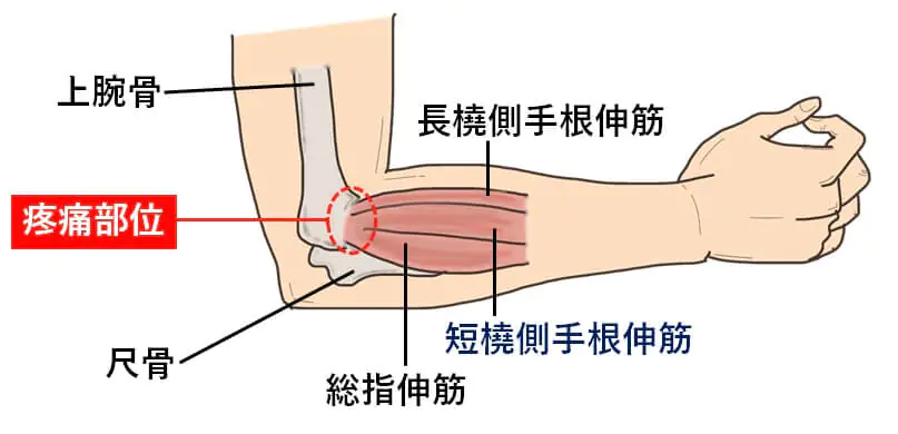 テニス肘(上腕骨外側上顆炎)とは