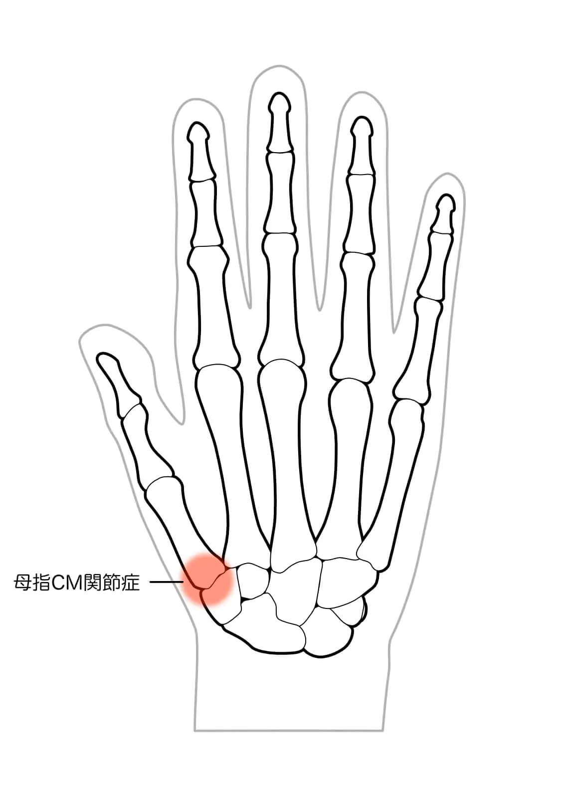 母指CM関節症とは