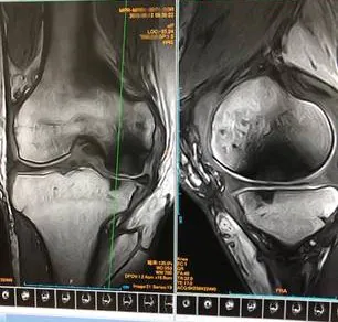 SW前初診時　MRI