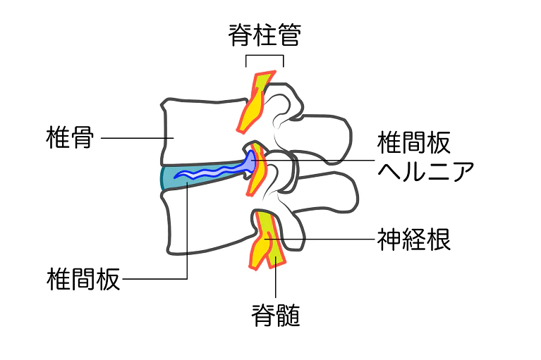 腰椎椎間板ヘルニアとは