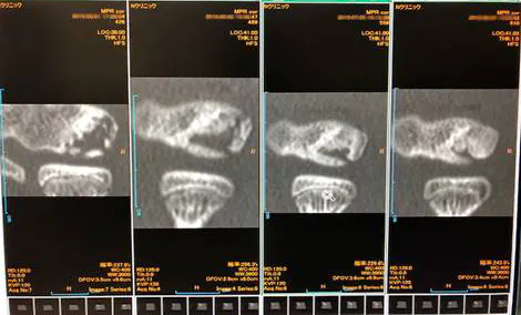 （左から）初診時CT　2か月後　4か月後　6か月後