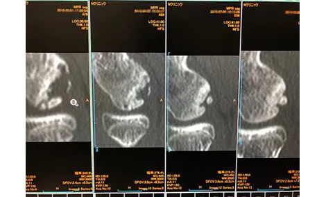 上腕骨小頭離断性骨軟骨炎