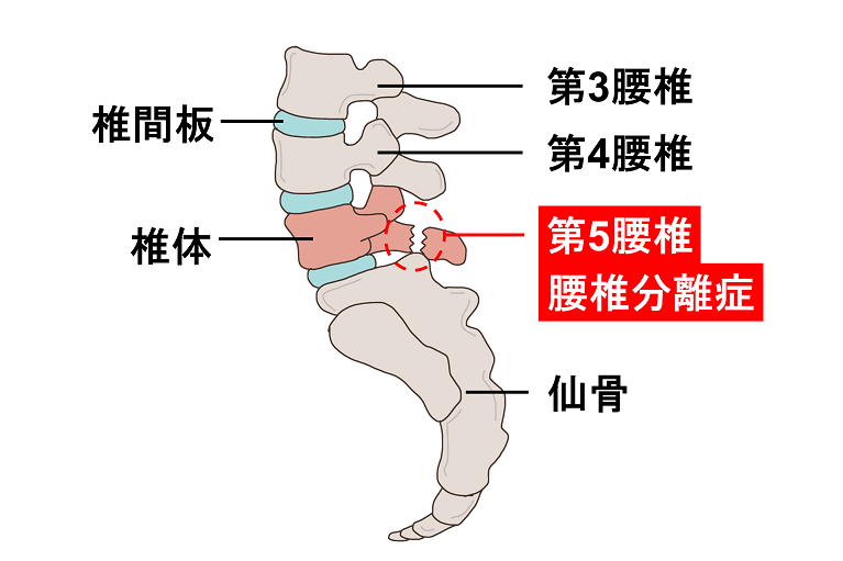 腰椎分離症とは